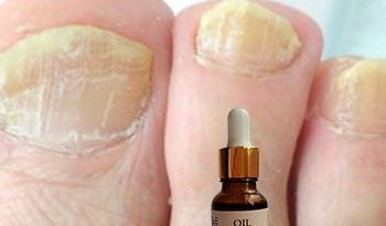 Масло «Монарды» для избавления от грибка ногтей